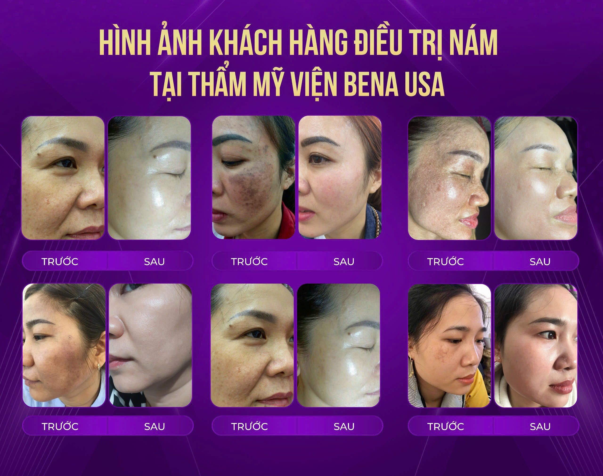 Nám, tàn nhang không còn là nỗi lo với phương pháp mới tại Bena USA